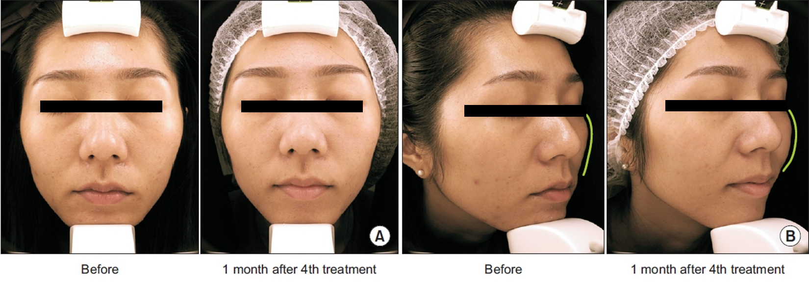 血小板凍晶 (PLT) 應用於改善臉部膚質